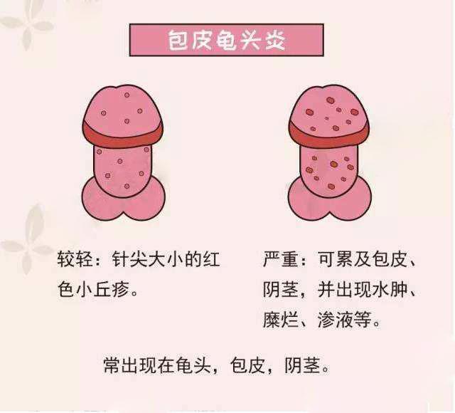 龟头炎诱因和症状有哪些