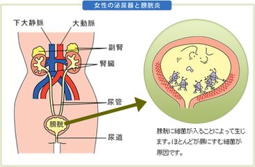 膀胱炎的并发症有哪些